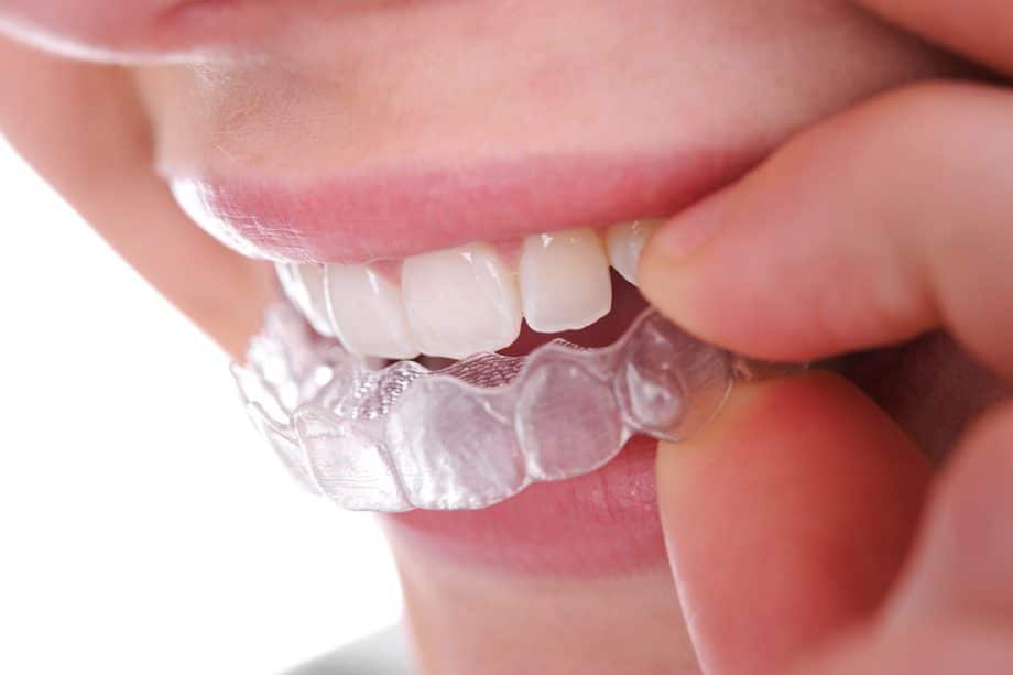 9 Tips to Keep Your Clear Aligners Clean