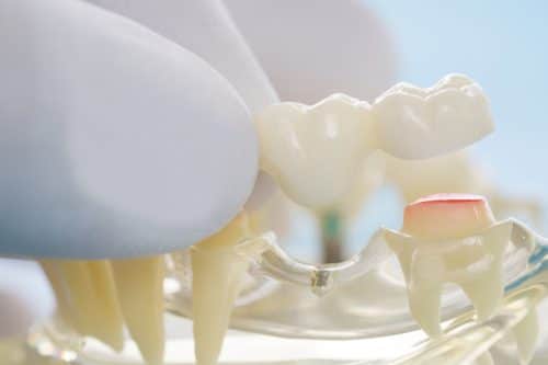 how-long-does-it-take-for-a-dental-bridge-to-settle-suwanee-ga